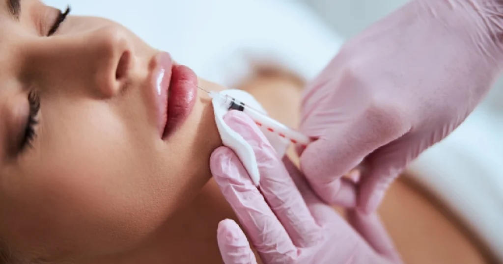 Lip filler injection